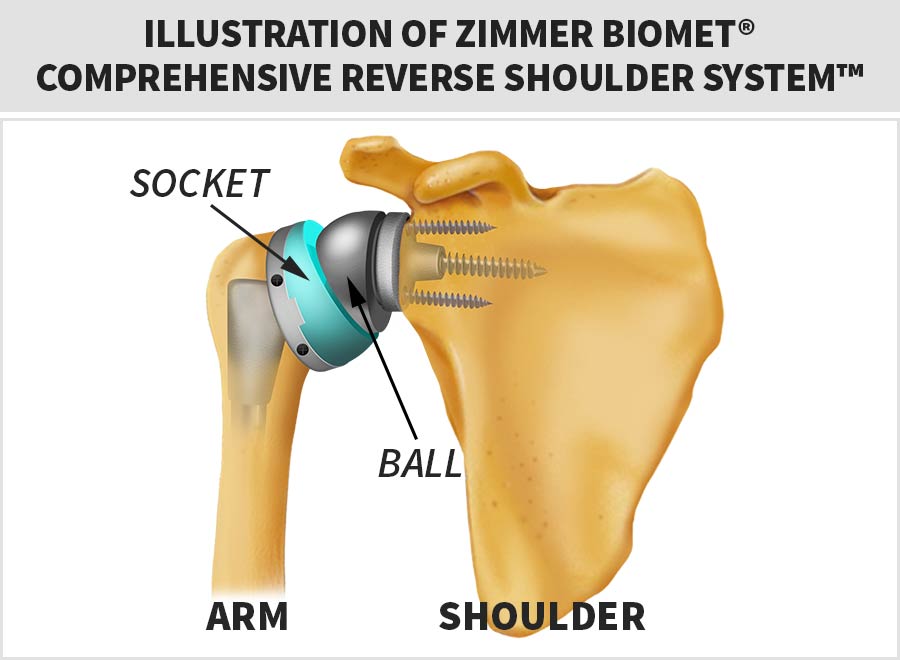 Zimmer Biomet Comprehensive Reverse Shoulder System Recall