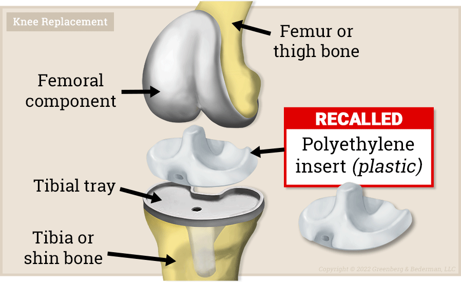 Total knee replacement lawsuit