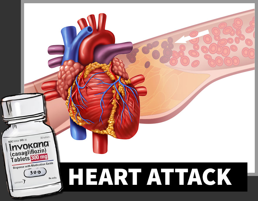 Invokana and Heart Attack