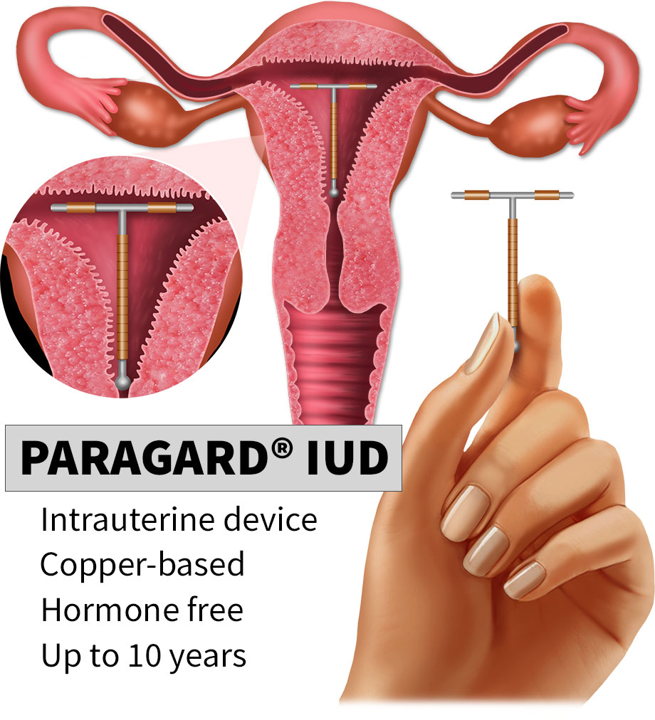 ParaGard IUD removal complications